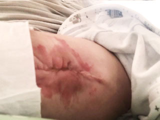 Spina Bifida Scar